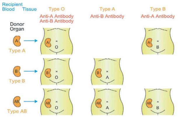 ΑΒΟ ασύμβατη μεταμόσχευση Αν και η ΑΒΟ ασύμβατη μεταμόσχευση αποτελεί αντένδειξη, η έλλειψη διαθέσιμων