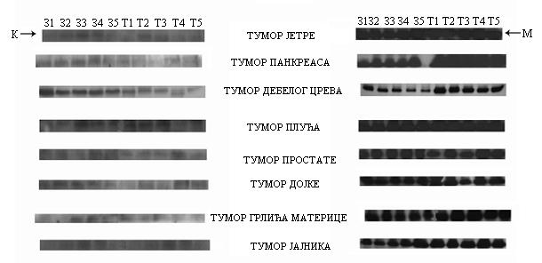 4.5 Молекулски облици IGFBP-2 код пацијената са различитим врстама тумора На моделу тумора дебелог црева је констатовано да је измењена заступљеност одређених молекулских облика IGFBP-2 показатељ
