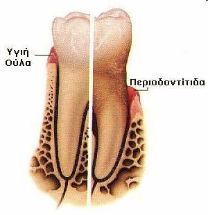 Αν η φροντίδα των δοντιών δεν είναι καλή τα δόντια καταστρέφονται Οι μικροοργανισμοί που ζουν