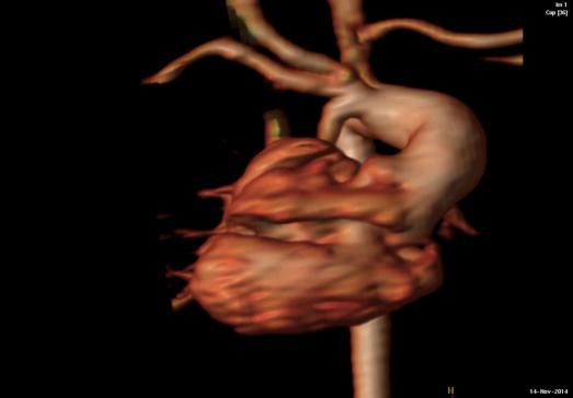 Criss cross heart with pulmonary