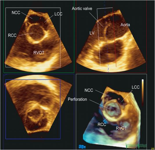 Ruptured aortic valve with severe AR Charakida,