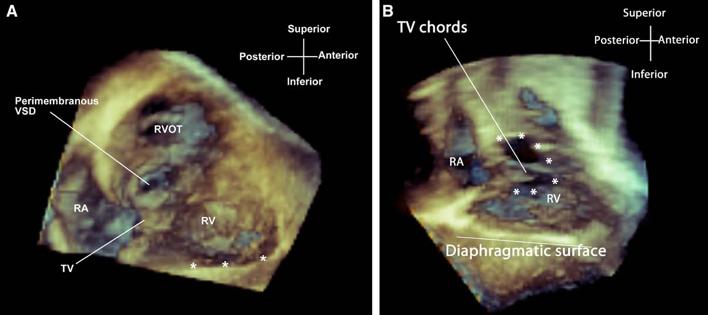 Ventricular septal defect with TV chordal Charakida,