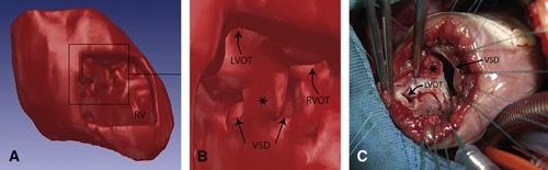 Figure 6 The Journal of Thoracic and Cardiovascular Surgery 2009 138, 571-580DOI: (10.1016/j.