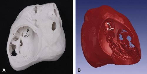 Figure 8 The Journal of Thoracic and Cardiovascular Surgery 2009 138, 571-580DOI: (10.1016/j.