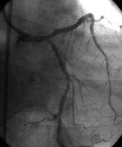 Τεχνικές 2 stents True bifurcations with