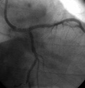 between MB & SB Culotte True bifurcations