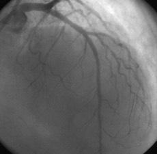 smaller angles and double BVS stenting to