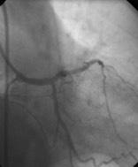 between MB & SB, dissection in both SB &