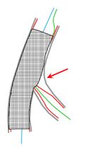 Διαδικασία της στρατηγικής 1 stent Βελτιστοποιήση του εγγύς τµήµατος του κύριου κλάδου.