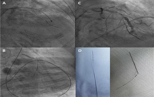 Ειδικές συσκευές (Rotablator) Coronary Perforation Caused by