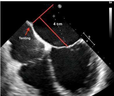 TEE in 4-chamber view tenting of the atrial septum can be seen as the transseptal needle is pushed against it, ideally in the superior and posterior part of the