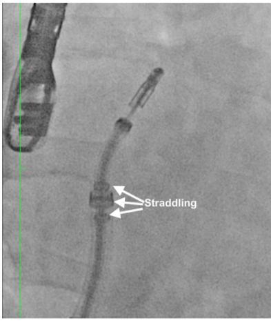 positioning of the MitraClip delivery system in the left atrium.