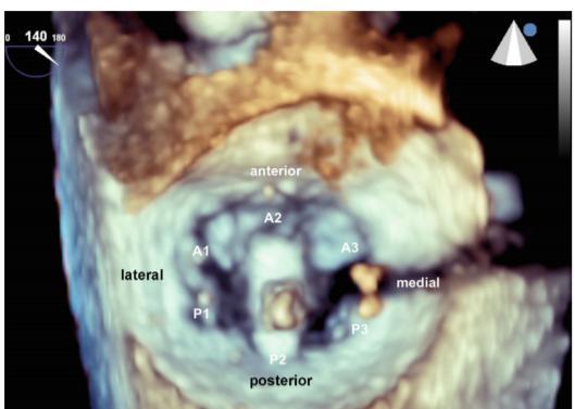 when the clip is adequately positioned above the middle segments of the mitral valve and