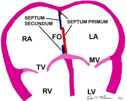 Stage II: the remaining part of the opening between the RA and LA closed by septum secundum.