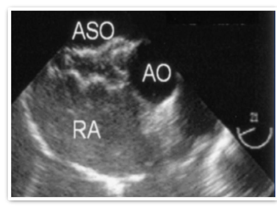 In 45% of cases for ASD closure.