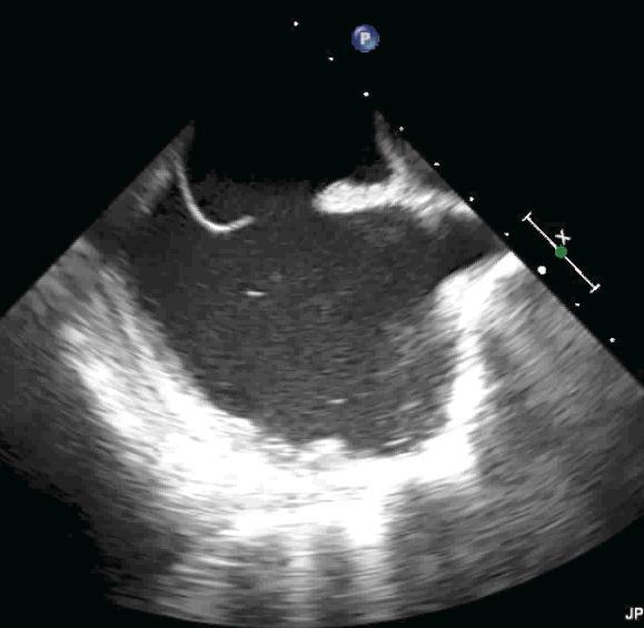 Balloon Oclusion Test Hemodynamic