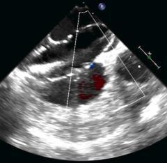 during 15 minutes Hemodynamic