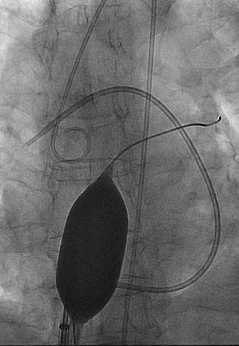 pressures, shunt and resistences