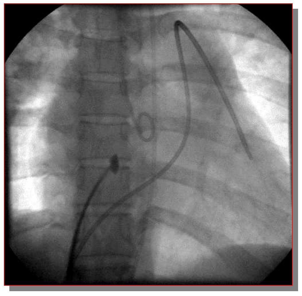 Antero posterior view G.