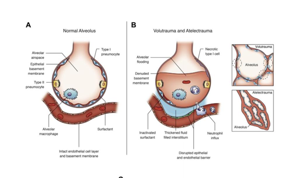 Ventilation Induced Lung