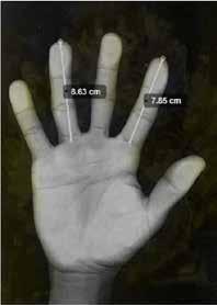 مقایسة نسبت طول انگشت دو به چهار )2D:4D( در 146 بهعنوان نمونة آماری شرکت کردند. به لحاظ رعایت مالحظات اخالقي تمام مراحل پژوهش به اطالع آزمودنيها رسید.