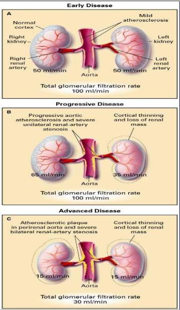 νόσο Στενωση της νεφρικής