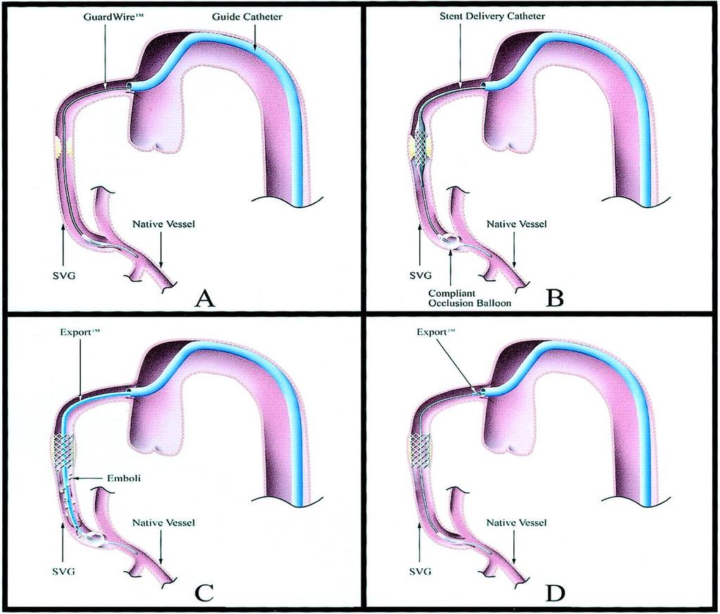 EPDs: Guardwire Baim D et al.