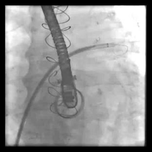 transeptal Transeptal sheath