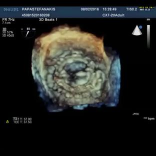 6 months later: increasing dyspnea and re-hemolysis RESIDUAL moderate POSTEROMEDIAL +