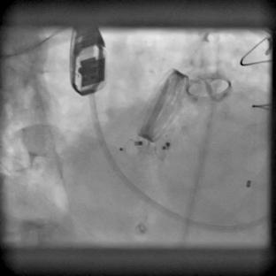 Transapical approach Both defects closed Posteromedial defect 2 nd