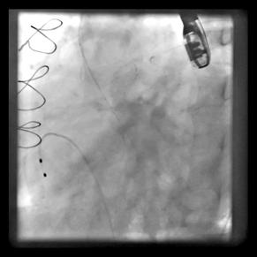 AORTOGRAM PRE