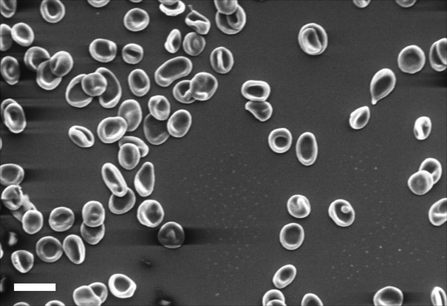 Εικόνα 12: Ενδεικτική μικροφωτογραφία ΗΜ Σάρωσης ερυθροκυττάρων ασθενούς που υποβάλλεται σε αιμοδιαδιήθηση (HDF), πριν από την αιμοκάθαρση. Ράβδος μεγέθυνσης: 10μm.