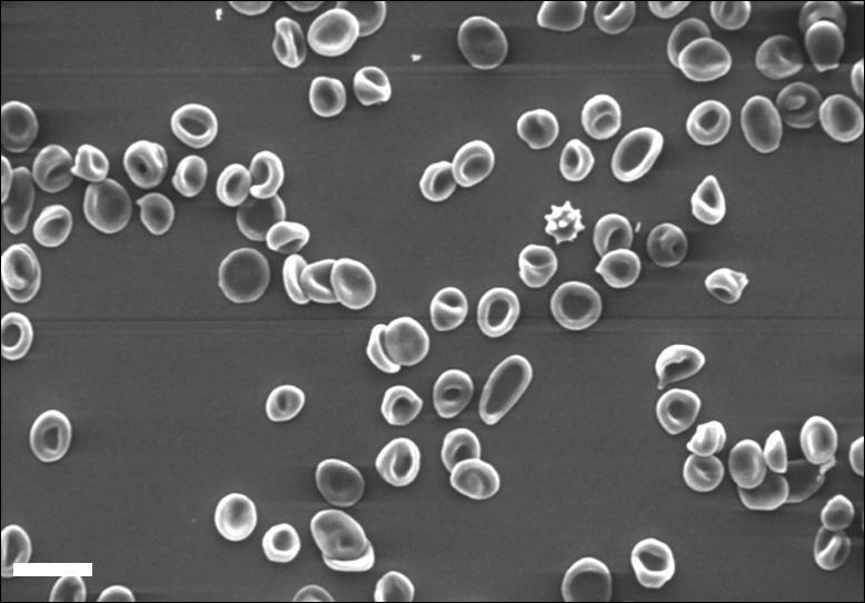 Εικόνα 13: Ενδεικτική μικροφωτογραφία ΗΜ Σάρωσης ασθενούς που υποβάλλεται σε συμβατική αιμοκάθαρση (HD), πριν από την αιμοκάθαρση. Ράβδος μεγέθυνσης: 10μm.