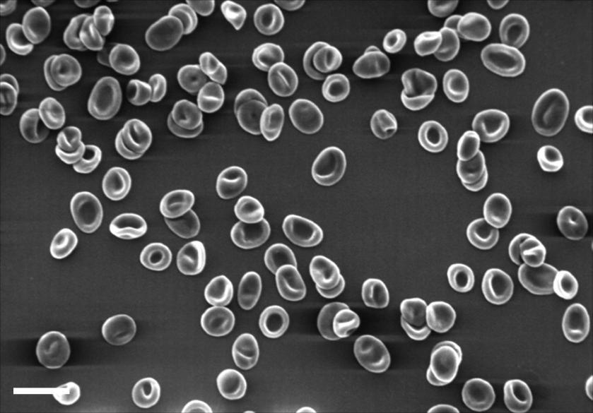 Εικόνα 16: Ενδεικτική φωτομικρογραφία ΗΜ Σάρωσης ερυθροκυττάρων ασθενούς που υποβάλλεται σε