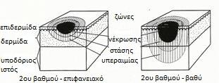 όπως ξηρότητα ή φλεγμονή. Η ζώνη της στάσης είναι πιο εμφανής σε μερικού και ολικού πάχους εγκαύματα, που μειώνονται τα εναπομείναντα ζώντα κύτταρα και έχουμε ελαττωμένη αιματική ροή.