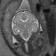 fetal MRI