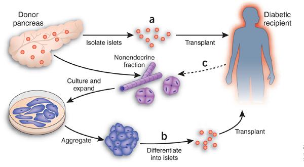 Νεότερες θεραπευτικές παρεµβάσεις Μεταµόσχευση παγκρέατος