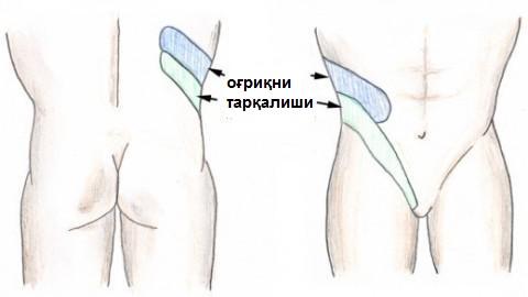 27-расм. Буйрак санчиғида оғриқнинг тарқалиши. Оғриқ бир неча сониядан бир неча соатгача давом этиши мумкин.
