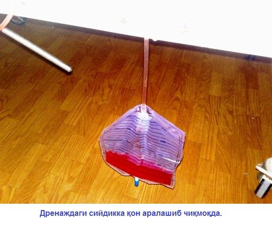 40-расм. Аммо дренаждаги сийдик қон билан интенсив аралашиб оқса, дренаж найчаси ичида қон лахаталари шакллана бошласа, бу - дренаж уланган аъзодан интенсив оқн кетаётганлиги аломати бўлиши мумкин.