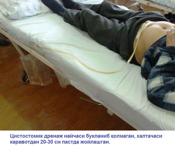 Қовуқдаги дренажни парваришлаш. Дренажни ташқаридан кўздан кечириш: букланиш, қисилиш, шикастланиш борми, табиий ранги ўзгарганми, аммиак ҳиди бор ёки йўқлиги аниқланади (42-расм).