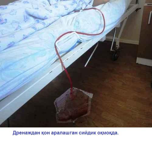43-расм. Қовуқнинг адекват дренажланиши учун дренаж ва сийдик йиғувчи халтачанинг дистал қисми, бемор ётганда кроватдан 25-30см пастда жойлашиши керак. Тик турганда бемор сони сатхида жойлашиши керак.