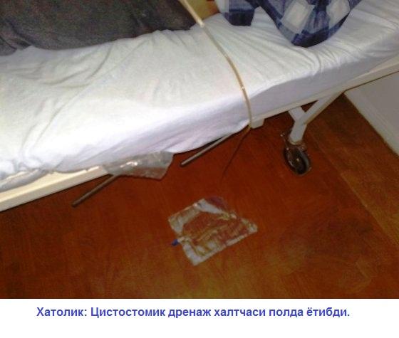 44-расм. Қовуққа инфекция киришининг олдини олиш учун ёпиқ системали дренаж ишлатилиши керак ва дренаж сийдик йиғувчи халтачадан очилмаслиги керак.