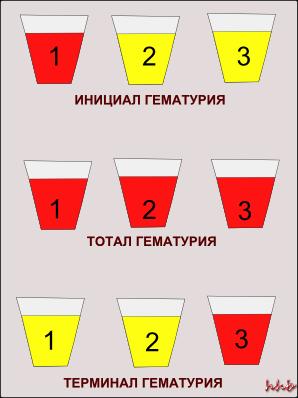 45-расм Бундан ташқари макроскопик ва микроскопик гематурия ҳам фарқланади. Макроскопик гематурия деб, кўздан кечирилганда қон бор сийдик ранги қизил бўлишига айтилади.