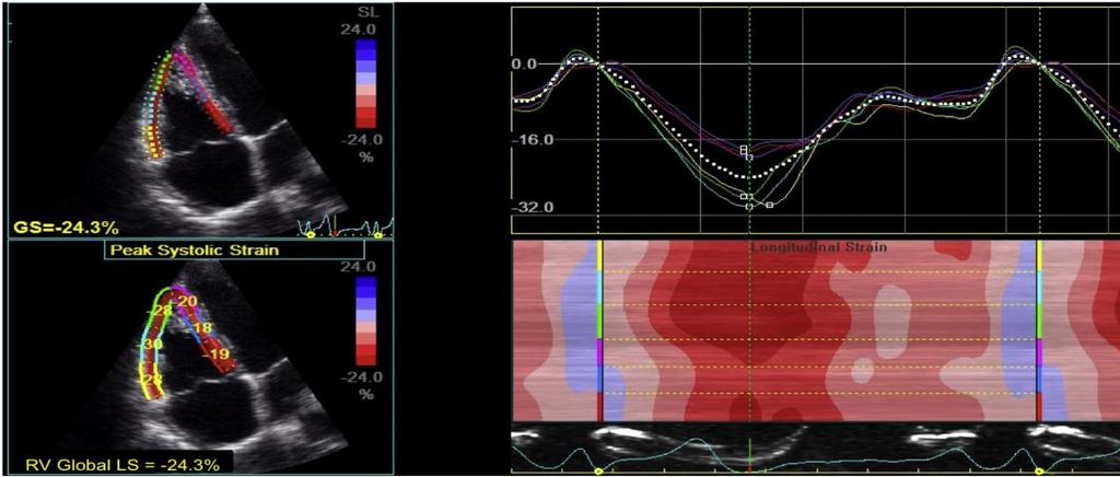 Speckle Tracking Echocardiography RV longitudinal strain: αποτελεί προγνωστικό παράγοντα καρδιαγγειακών συμβαμάτων και ολικής θνητότητας STE: δεν είναι τόσο αξιόπιστο στη λεπτοτοιχωματική