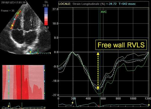 Speckle Tracking Echocardiography RV free-wall strain by STE: παρουσιάζει πολύ καλή συσχέτιση με