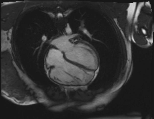 RV mass/volume ratio RV eccentric hypertrophy (<0.