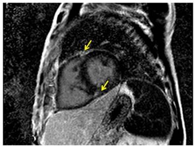 Την πρόγνωση υποθηκεύουν ιδιαιτέρως η ενδεικτική ίνωσης εναπόθεση γαδολινίου (LGE imaging) στα σημεία σύνδεσης των κοιλιών (junctional pattern),