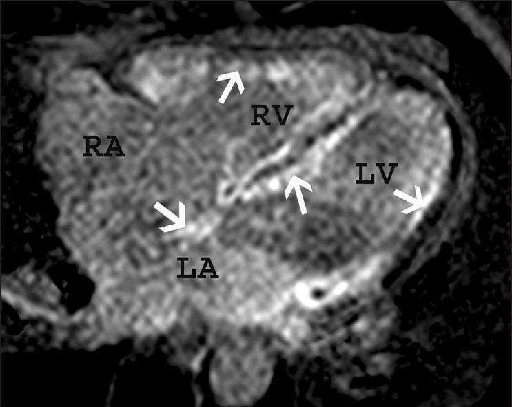 SARCOIDOSIS