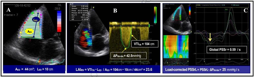 Συνδυαστικοί δείκτες απόδοσης ΔΚ afterload-corrected peak systolic longitudinal strain rate RV load-adaptation index (LAIRV) Ενσωματώνει το peak global systolic longitudinal strain rate και το φορτίο