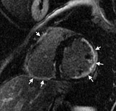 Dilated hypokinetic RV Increased RVESV, RVEDV Localized aneurysms